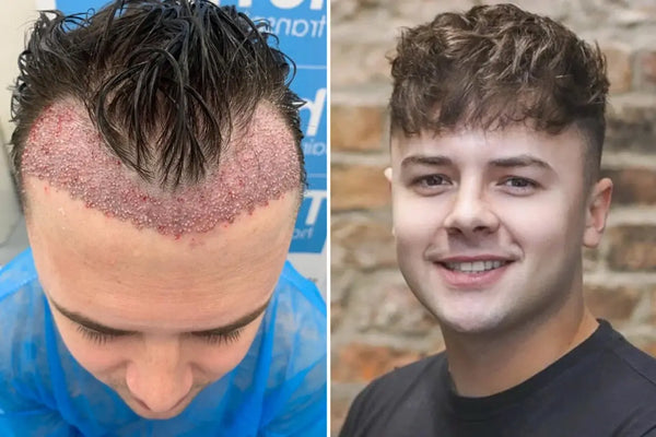 Brit, 26, left with horrific scars after botched hair transplant