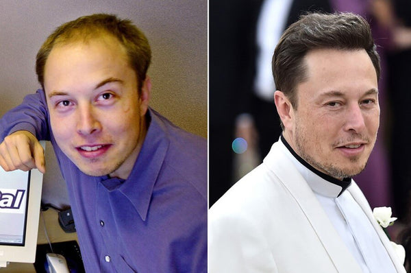 Elon Musk Hair Transplants 