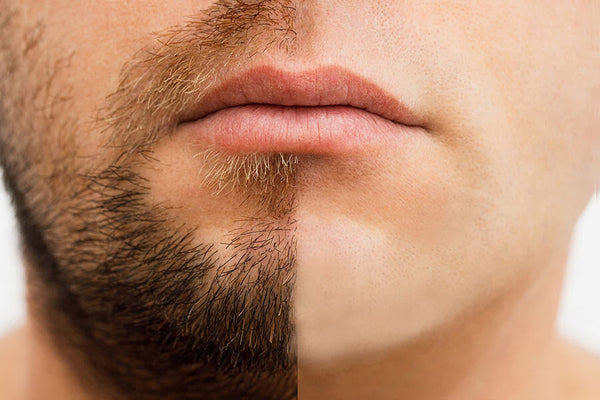 Laser beard removal before and after - example photo, before and after treatment.