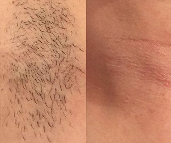 Laser beard removal before and after - close up, before and after treatment.