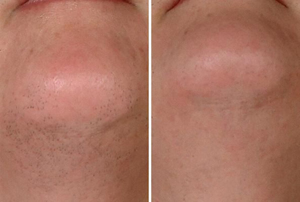 Laser beard removal before and after - example photo, before and after treatment under chin.