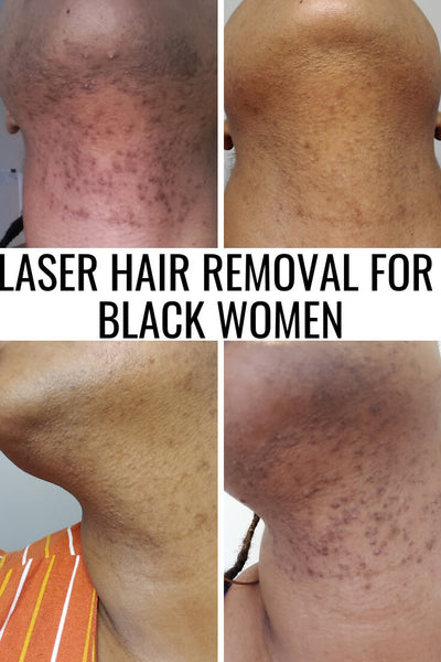 What is Laser Beard Shaping? Hair removal for men. – Daily Grind