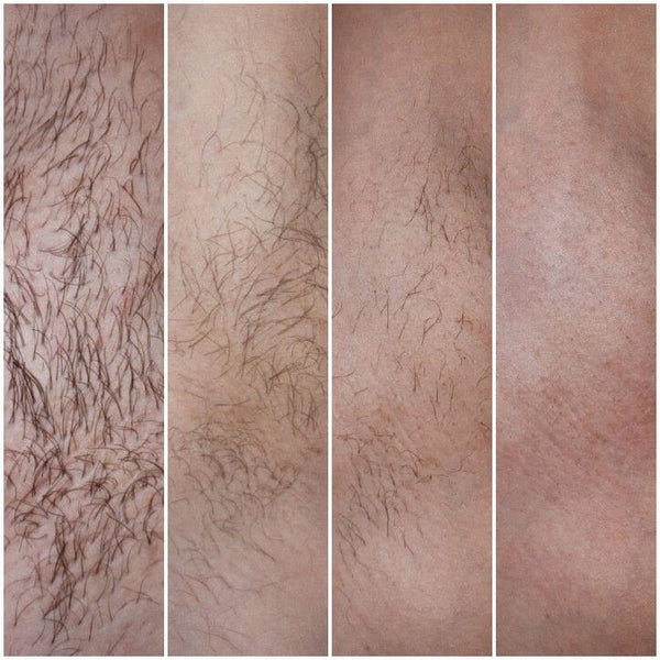 Laser beard removal before and after - example photo, before and after treatment.