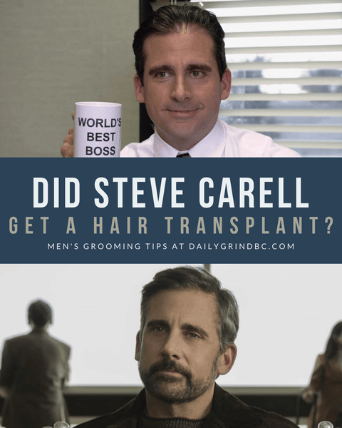 Steve Carell Hair Transplant before and after