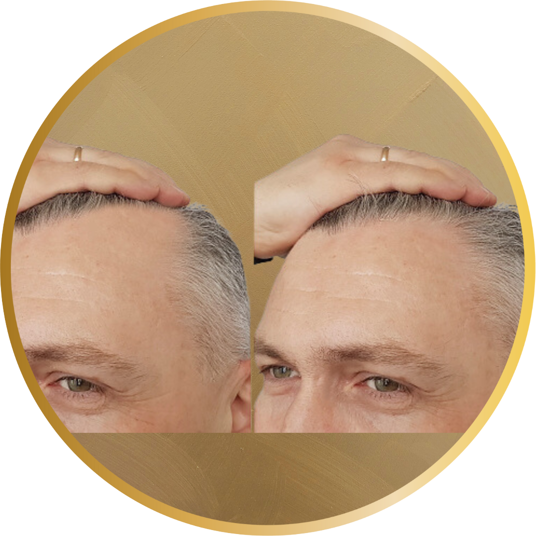 Receding hairline on male before and after Laser Hair regrowth therapy