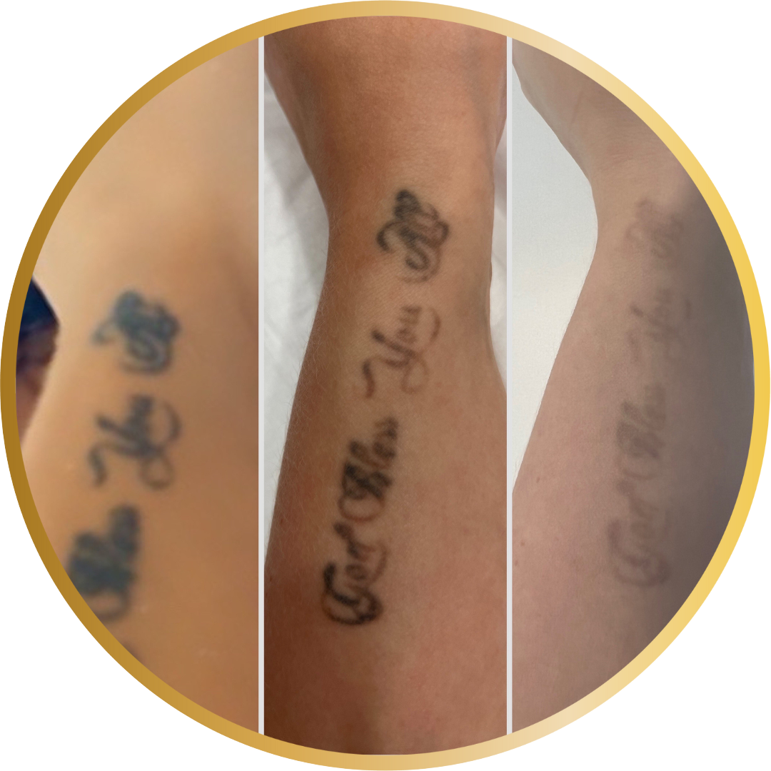 3 images of tattoo removal from first to third sessions. Shows results with tattoo image fading between sessions