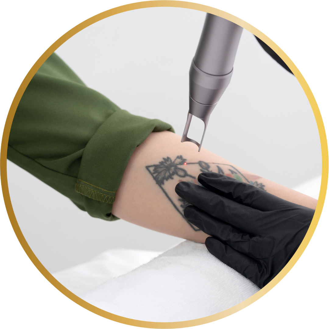 close up of Picosecond Laser Tattoo Removal, showing red laser beam on tattoo pigment