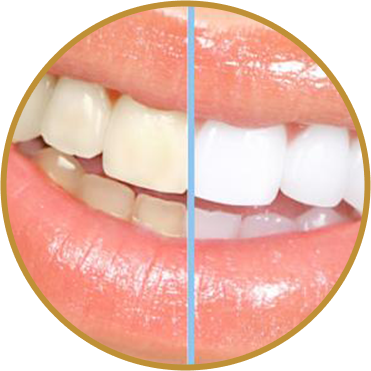 Close up of before and after of professional LED teeth whitening