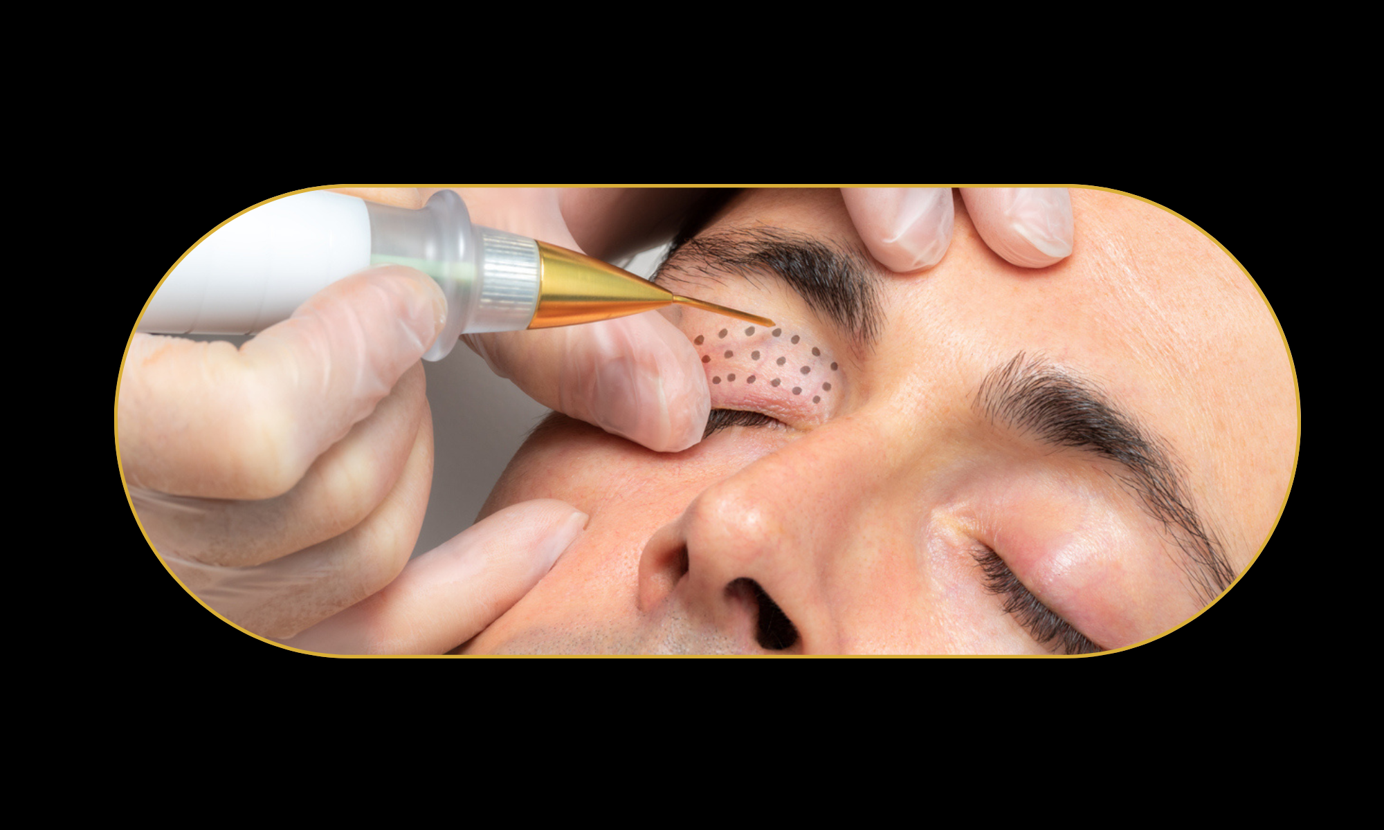 Close up of a man being treated for saggy eyelids with plasma Fibroblast. Small dots are over his eyelid