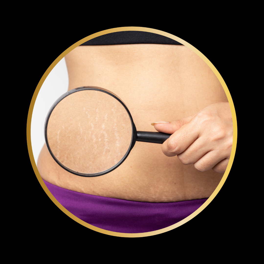 Torso stretch marks of lady with magnifying glass on worst area