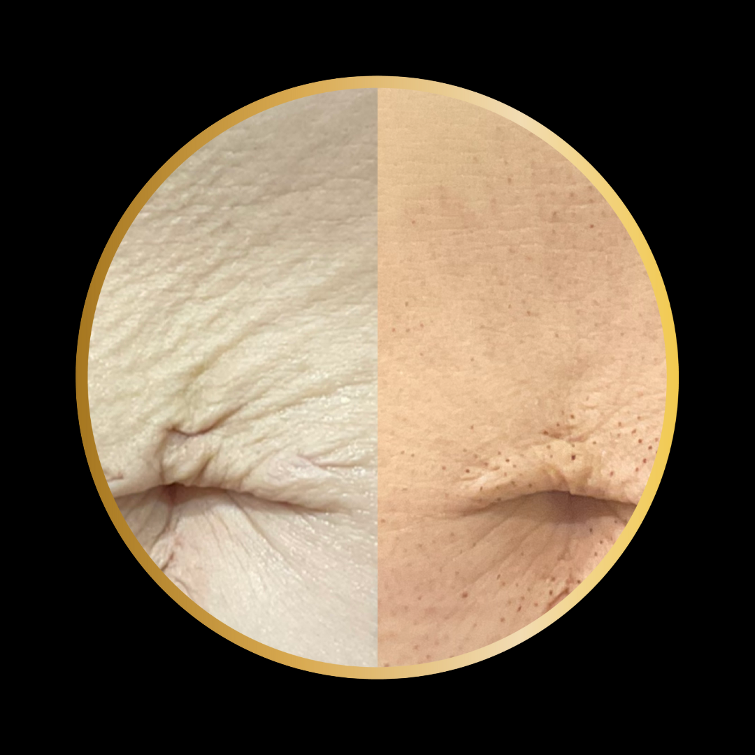 Close up of before and after of belly button area showing improvement with Plasma Fibroblast