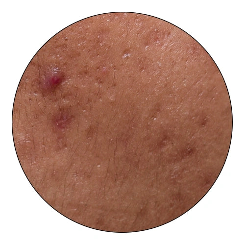 Clears acne-causing bacteria