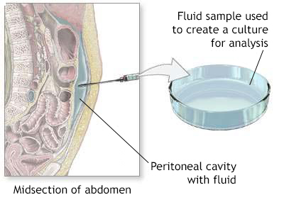 endometriosis-peritoneal-cavity