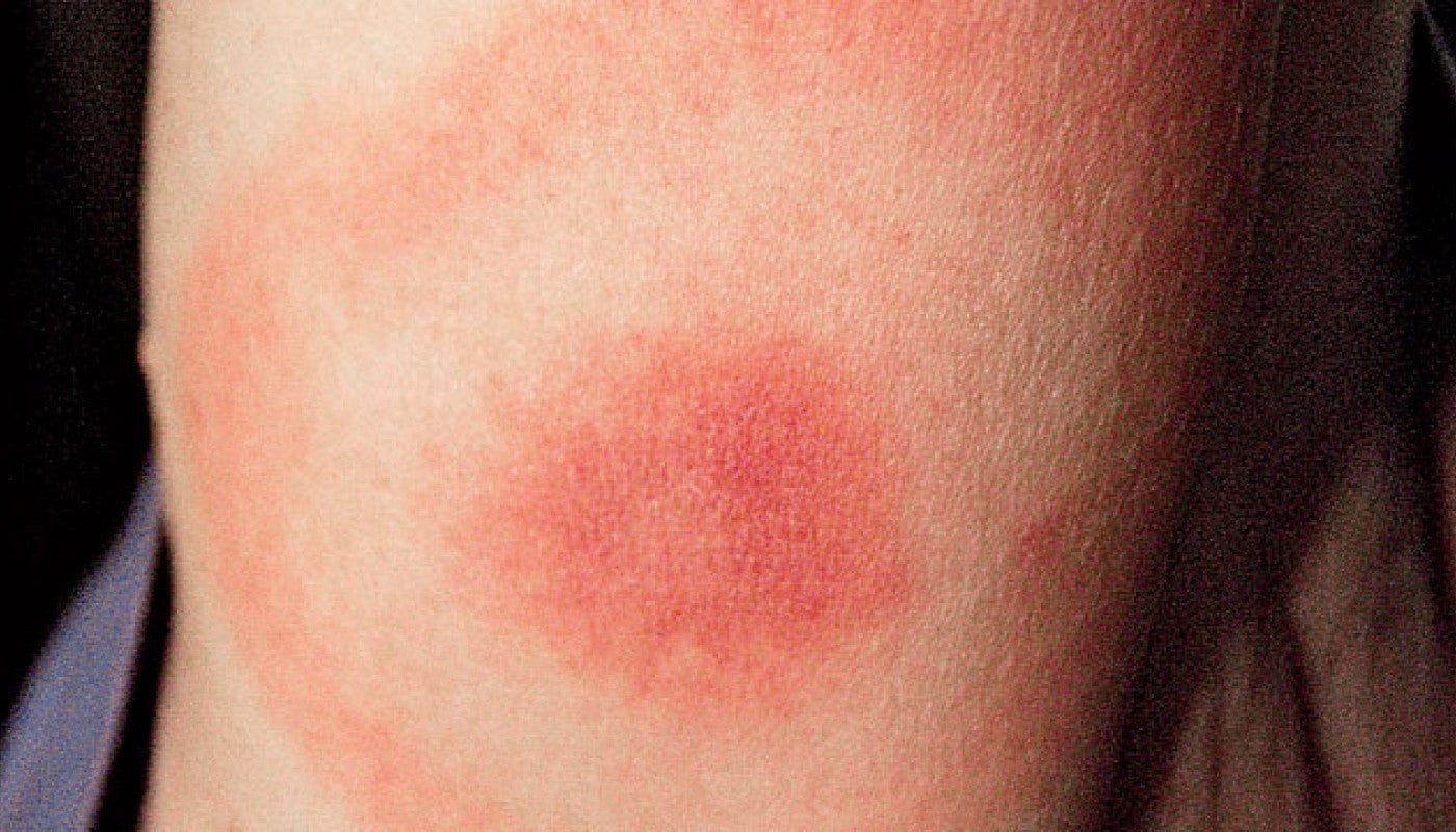 do tick bites itch and hurt and burn