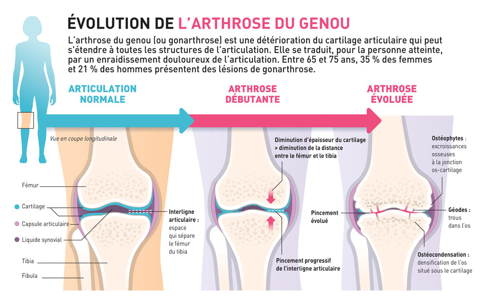 infographie évolution de l'arthrose du genoux