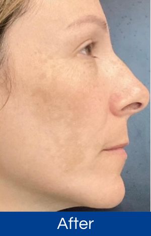 Profile view of a woman’s face with improved skin tone labeled 'After'.