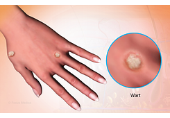 WartClearPLUS Instant Wart Removal Ointment