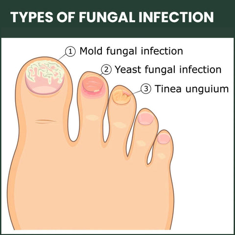 LifeMed Home Use Onychomycosis Fungal Laser Treatment