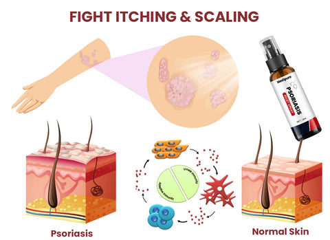 Medipure Psoriasis Relief Spray
