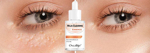 Oveallgo™ Milia Clearing Essence