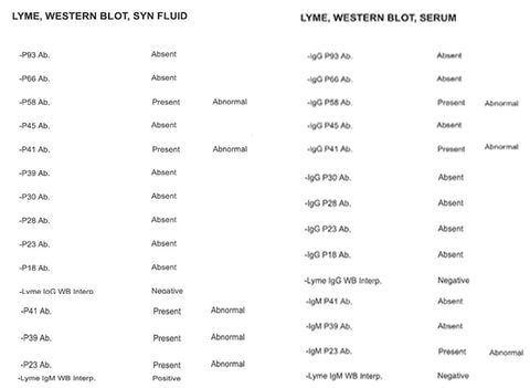 serum versus synovial lyme results