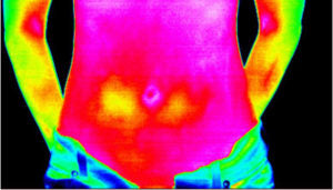pseudoappendicitis thermography image