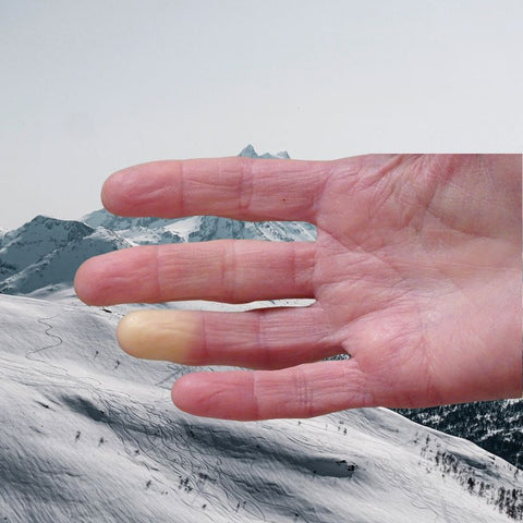 gérer syndrome raynaud