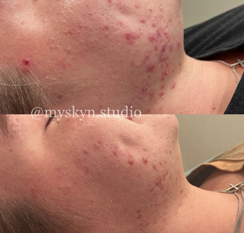 Acne Program Austin Texas