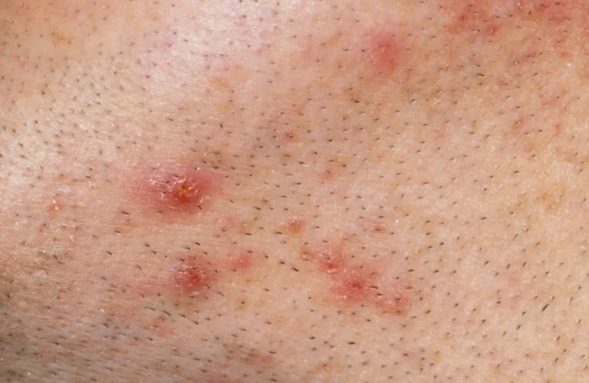 bumps after laser hair removal