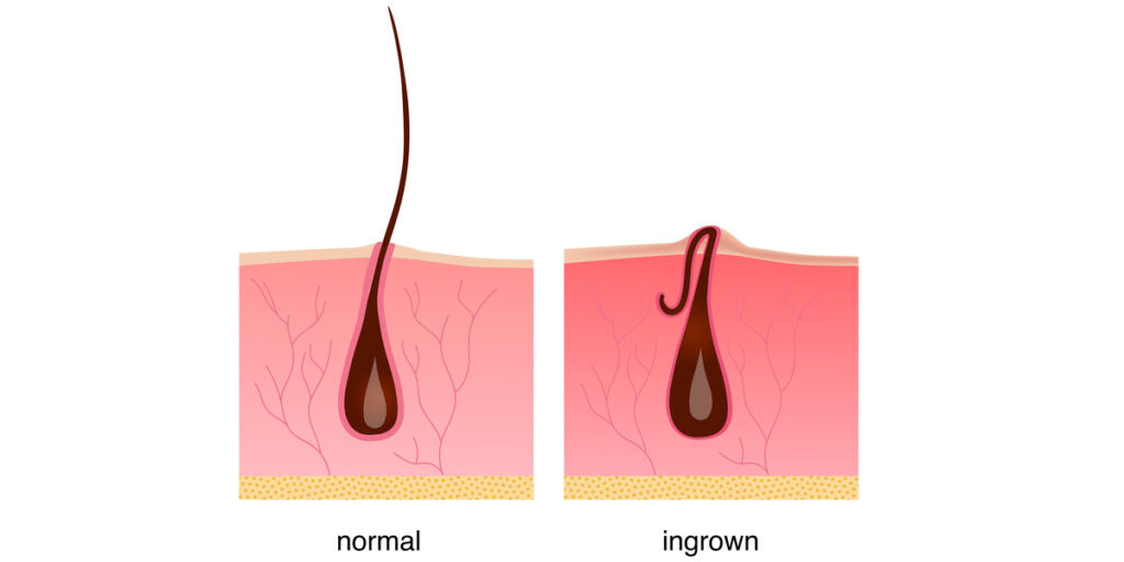 ingrown hair after laser hair removal