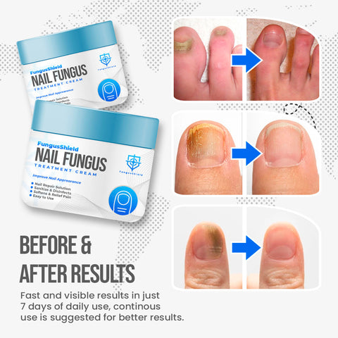 Fungus treatments keep finger and toenails in good form | UCLA Health