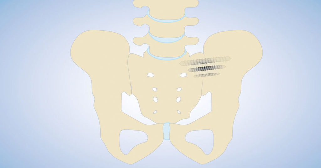 What is Sacroiliitis, Causes, symptoms, and treatment? - Bad Back Remedy