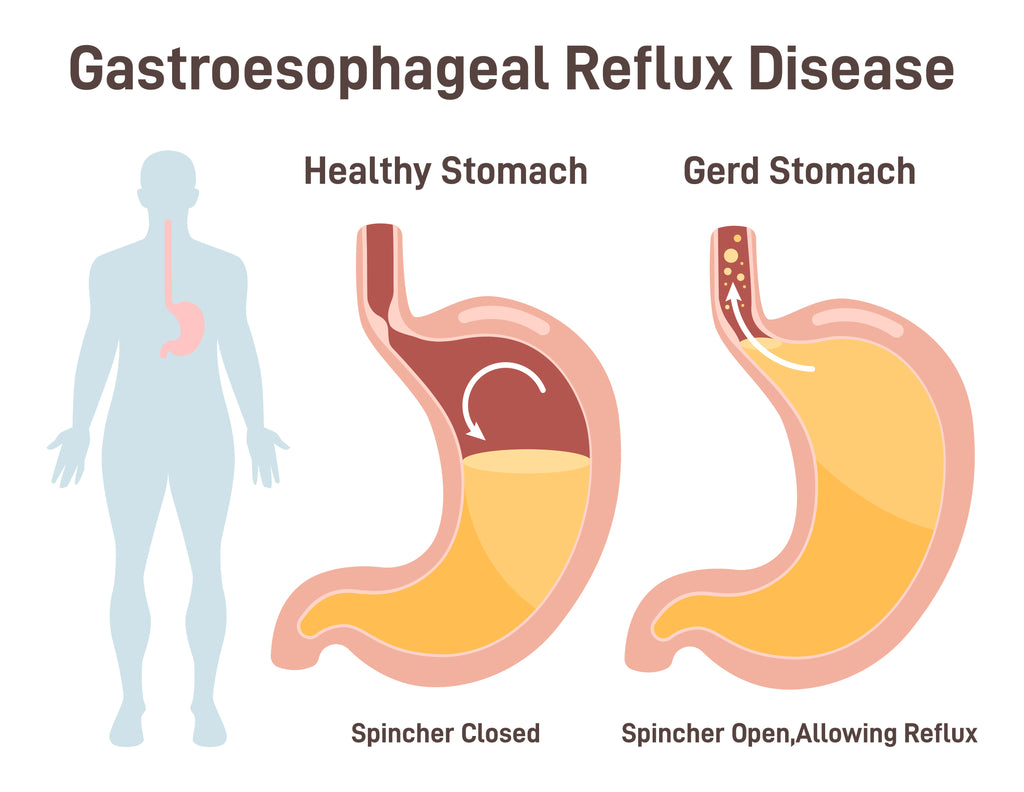 How to manage acid reflux