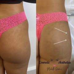 Non-Surgical Hip Dip Filler Treatment Using HYACorp - KLNIK – klnik