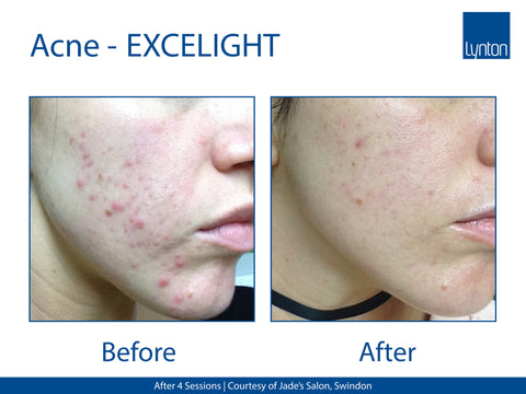 EXCELIGHT - Acne - Jade's Salon