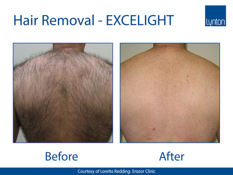 IPL Laser Hair Removal Back