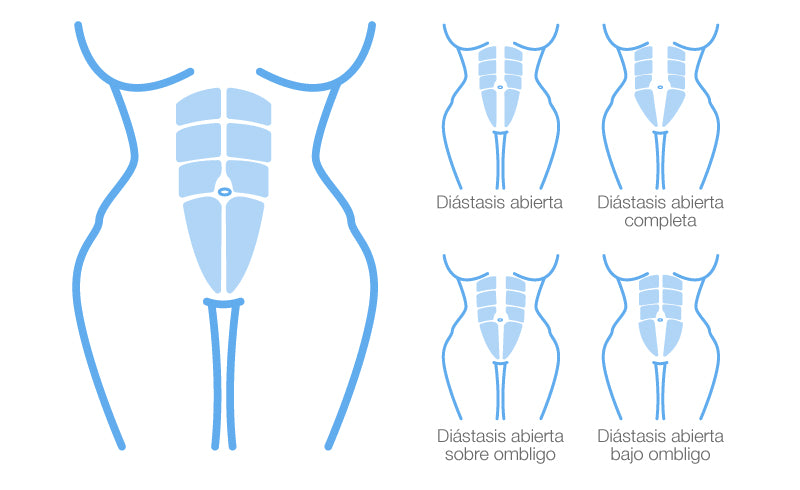 Below, I show you a chart with the possible types of abdominal separation that can occur: