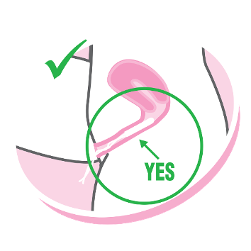 illustration of the properly inserted tampon