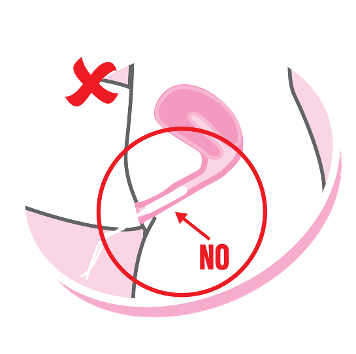 illustration of an incorrectly inserted tampon