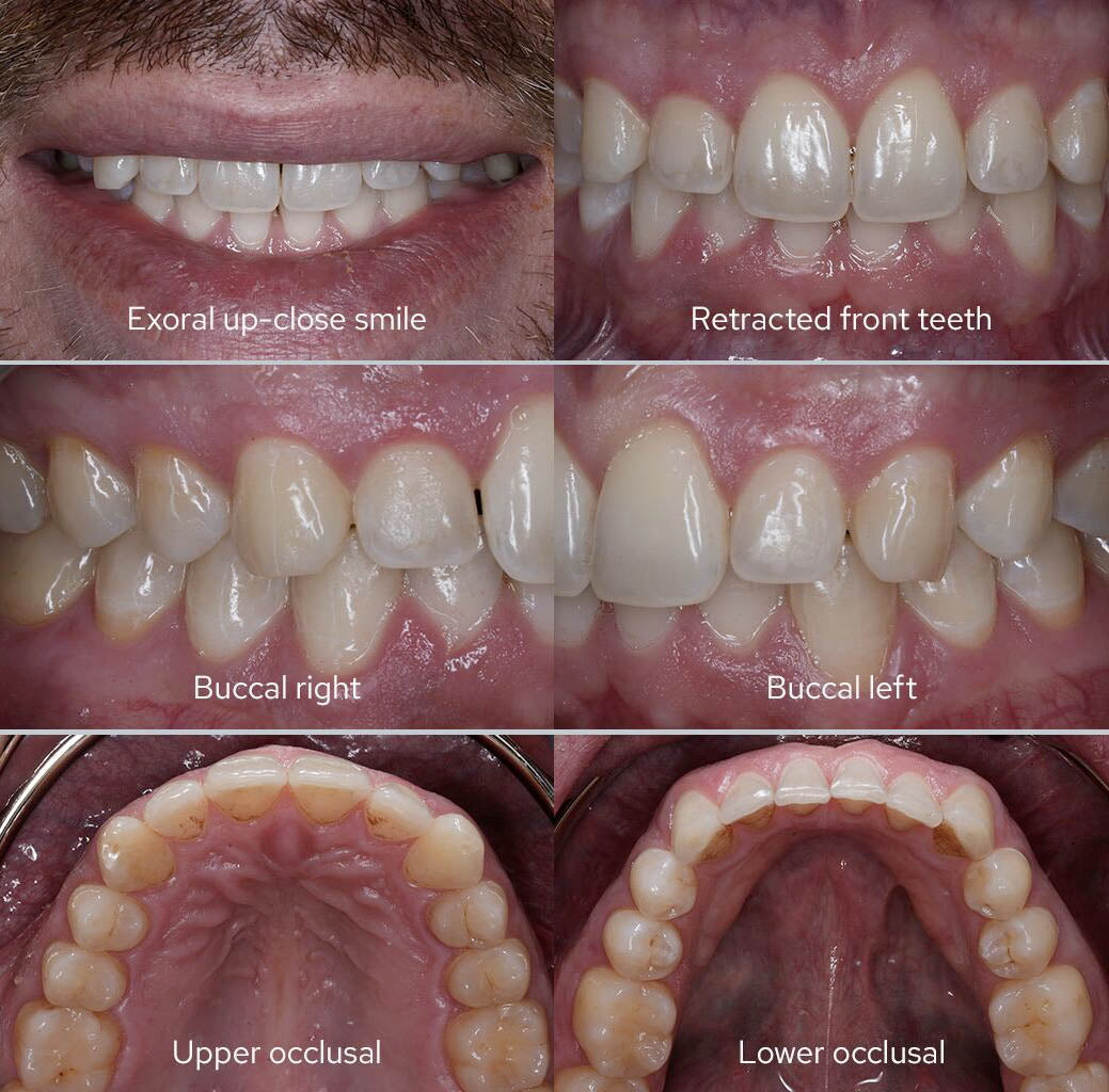 Examples of Dental Images taken using the Godox MF-R76S+ Dental Ring Flash