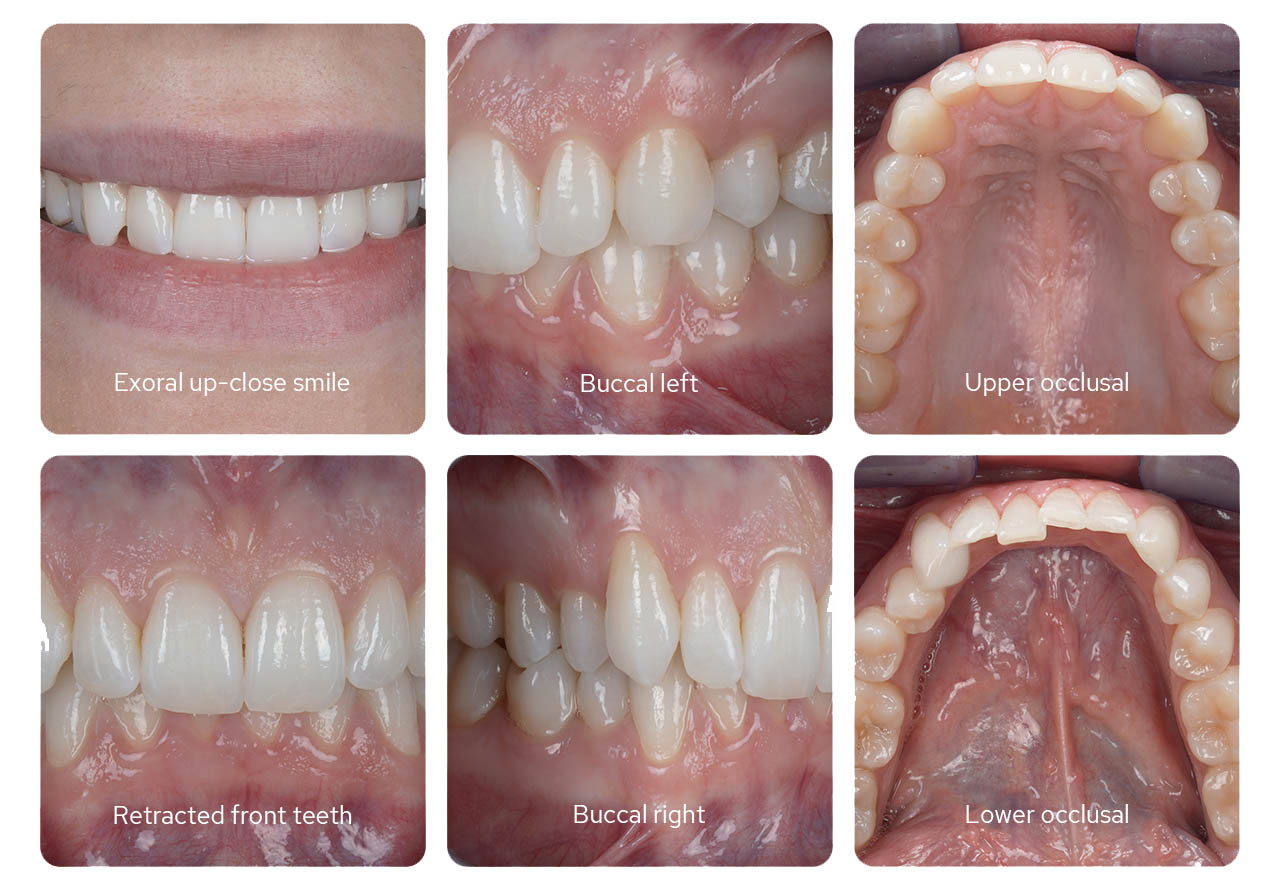 Example Dental Photographs taken with the MF12-DK1 Kit