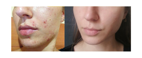 acne-avant-apres-arret-pilule-diane-35-sopk-solutions-remedes-naturel