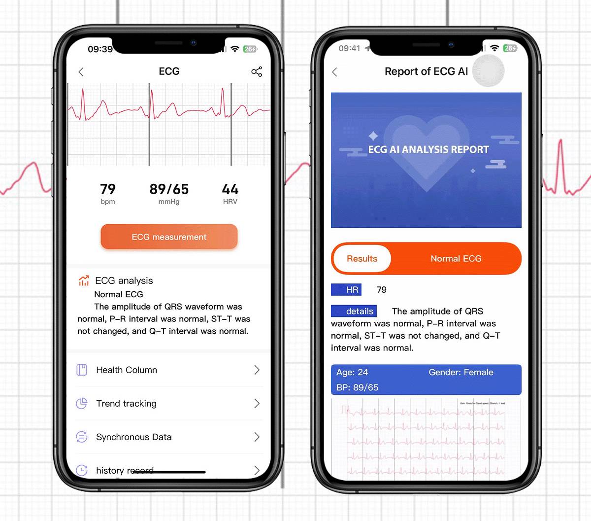 ECG smatwatch