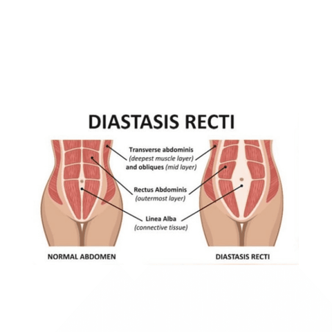 Diastasis recti image 