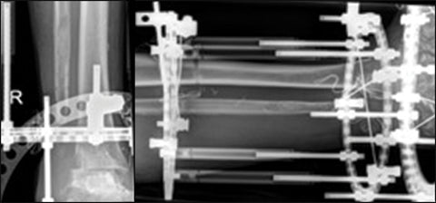 Fig 5a+b AP and lateral XRs of Ilizarov frame fusion