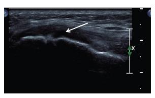 Ultrasound image showing hypoechoic change underneath superficial MCL