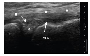 Ultrasound image showing medial meniscus with hypoechoic cleft
