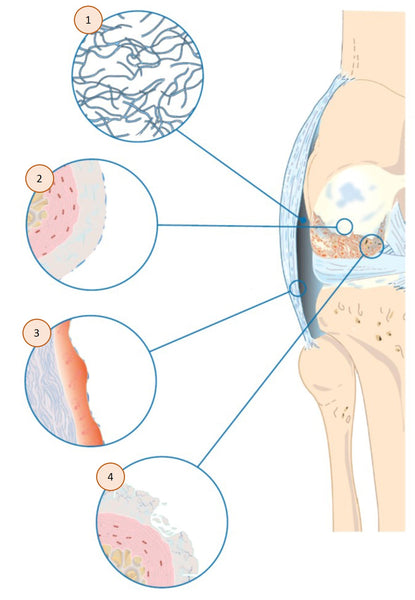 Damage in synovial joint due to osteoarthritis