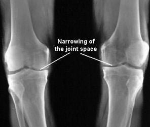 X-ray image of arthritis in the knee