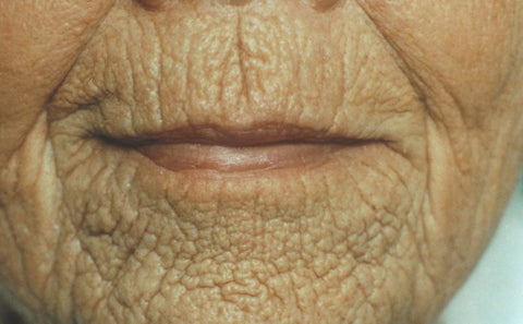 Diabetes patient with glycated collagen